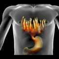 Triggers of Heartburn and Acid Reflux - Understanding Gut Health for Better Digestive Wellness