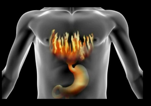 Triggers of Heartburn and Acid Reflux - Understanding Gut Health for Better Digestive Wellness